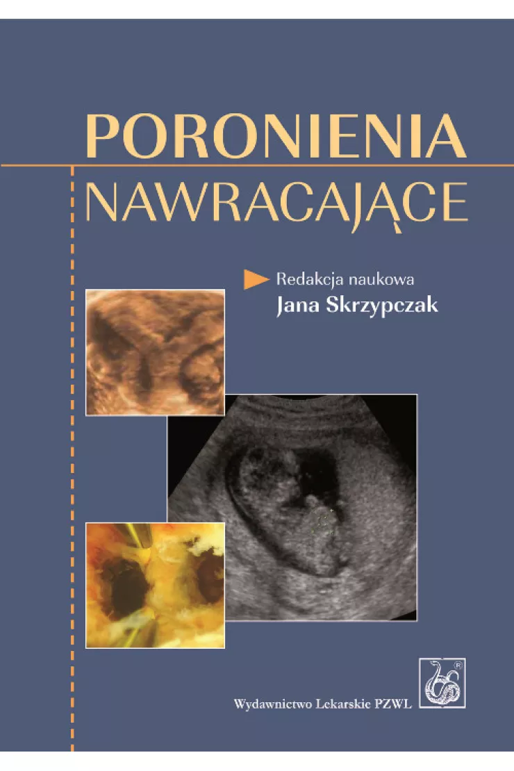 Poronienia nawracające